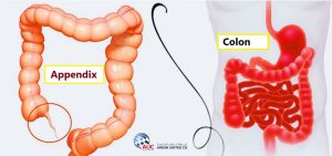 Differences Between Appendicitis and IBS Symptoms