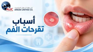 أسباب تقرحات الفم